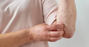 tanda penyakit campak